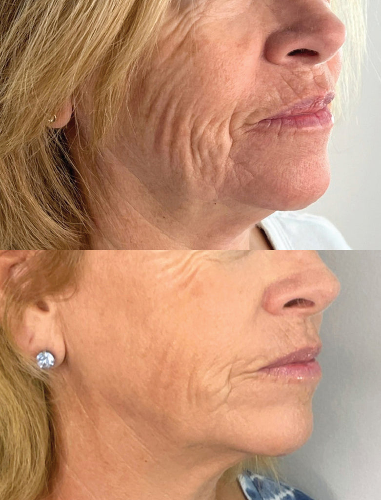 Before and After of RF Microneedling treatment on the cheeks.