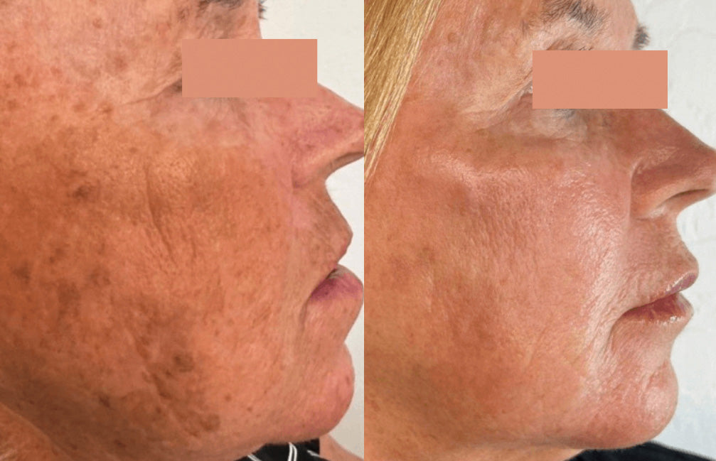 Beforea and After of IPL Photofacial for Age Spots and Sun Spots
