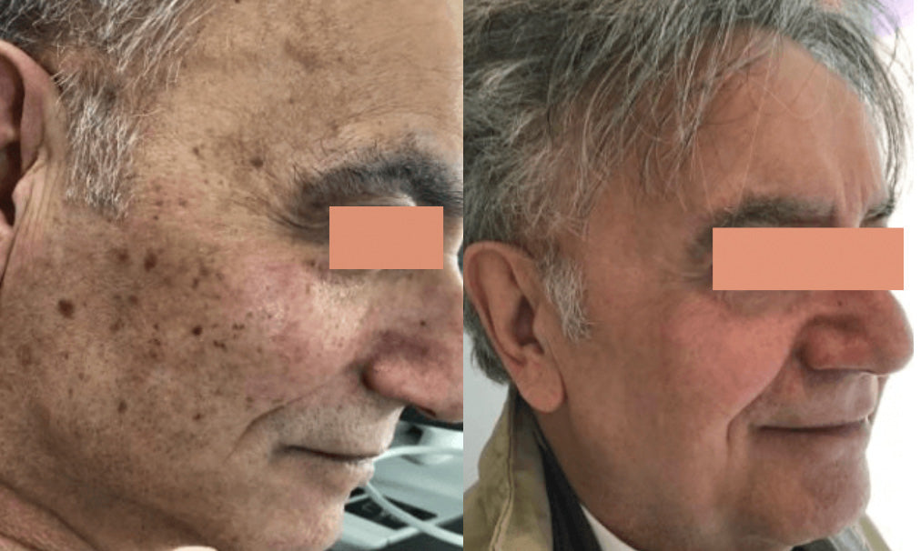 Beforea and After of IPL Photofacial for Age Spots and Sun Spots