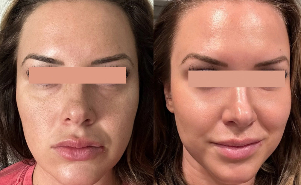 Beforea and After of IPL Photofacial