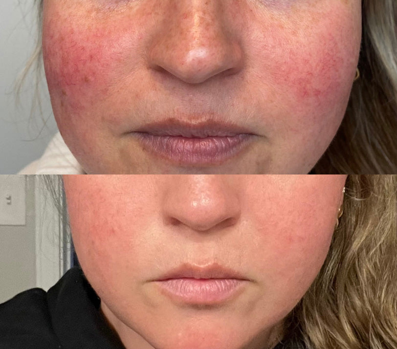 Beforea and After of IPL Photofacial for Rosacea