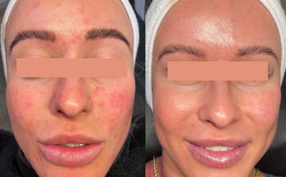 Beforea and After of IPL Photofacial for Rosacea and Skin Issues