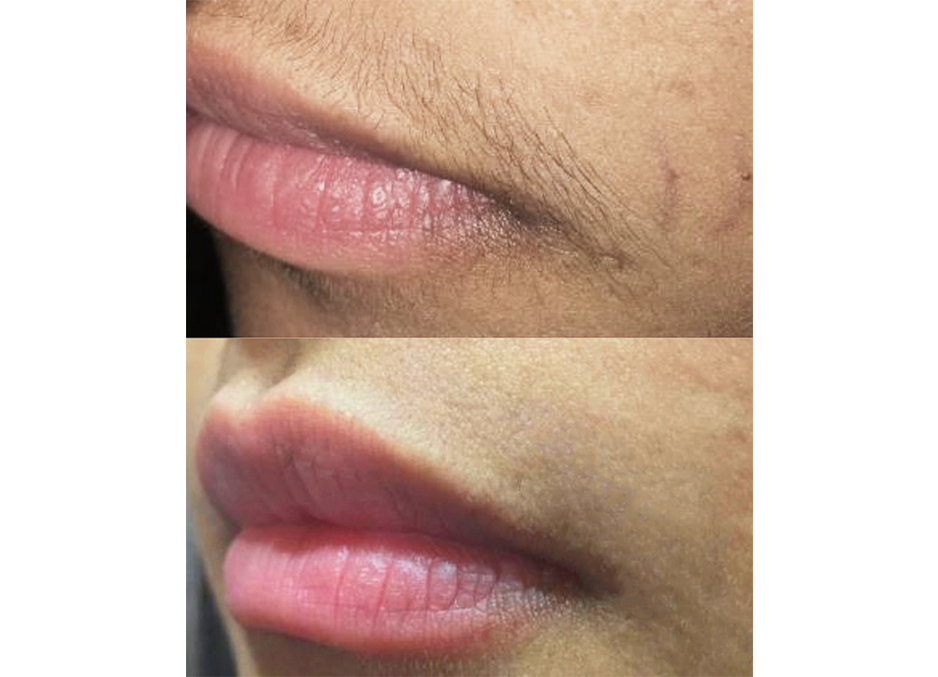 Before and after of Pain Free Laser Hair Removal on a woman's upper lip