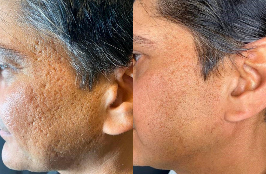 Before and after of RF Microneedling treatment on the cheeks and face, showing substantial acne scarring removal.