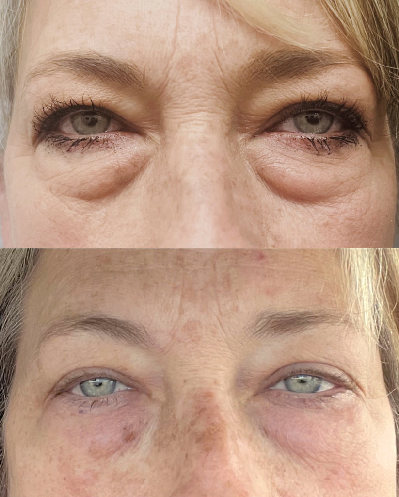 Before and after of RF Microneedling treatment on the eyes, particularly the eyebags. 