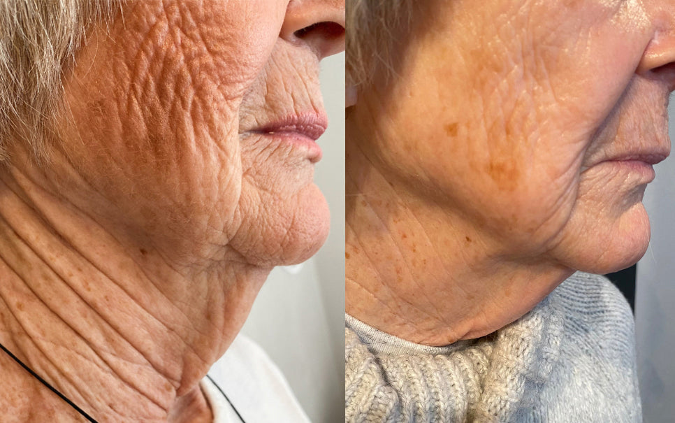 Before and after of RF Microneedling on the face and neck, showing skin rejuvenation and wrinkle reduction.