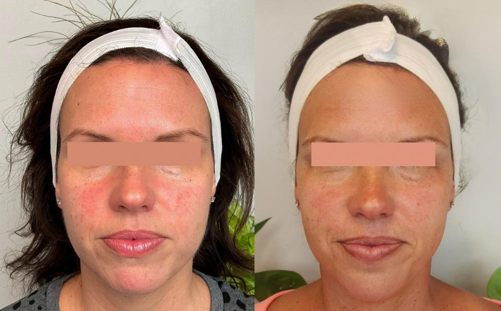 Beforea and After of IPL Photofacial for Rosacea