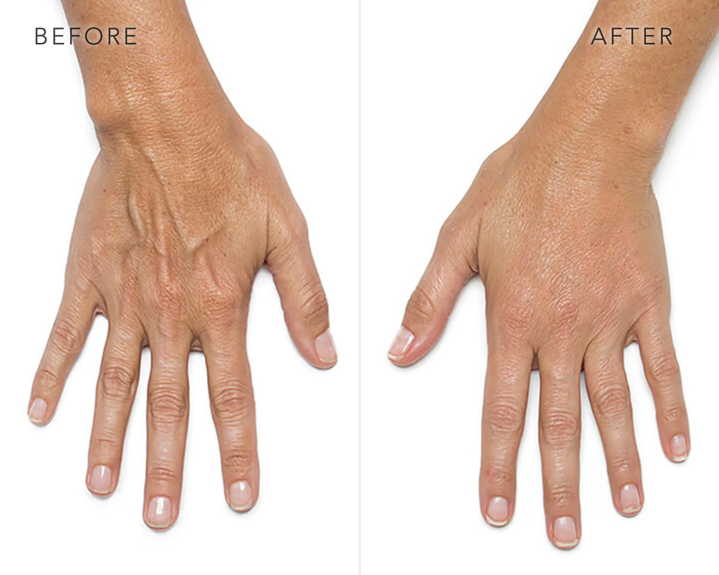 Radiesse Hands Before and After