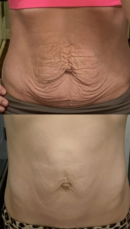 Before and After of RF Microneedling Treatment on a stomach.