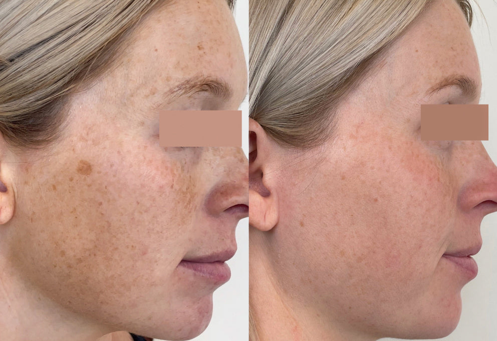 Before and after of RF Microneedling on the face, showing rejuvenation and pigmentation removal.